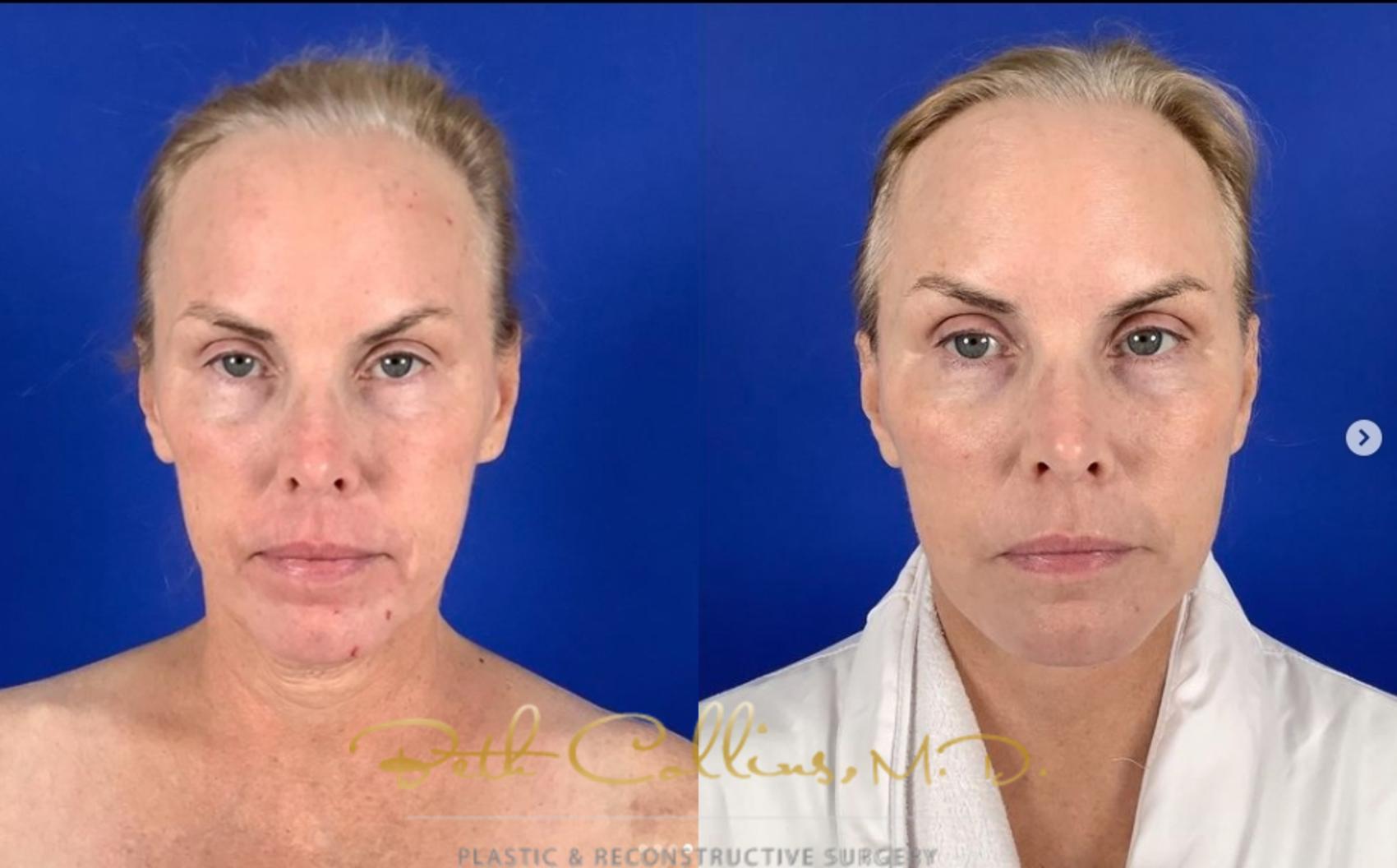 Before & After Deep Plane Facelift Case 274 Front View in Guilford, CT