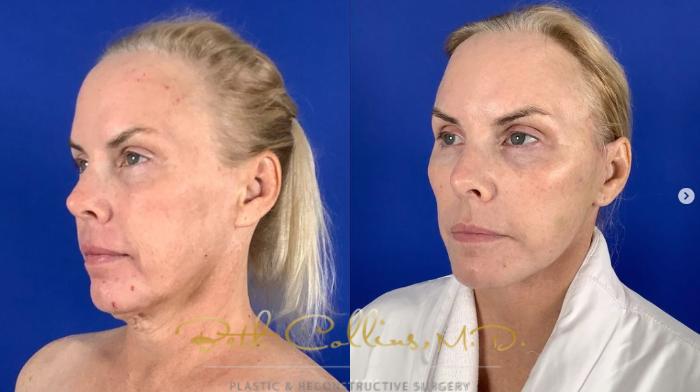 Before & After Deep Plane Facelift Case 274 Left Oblique View in Guilford, CT