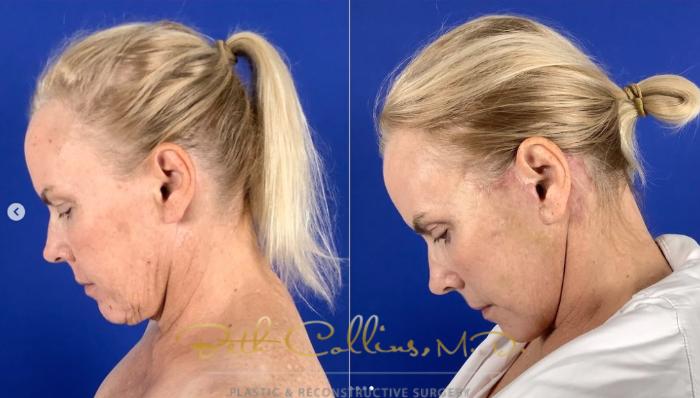 Before & After Neck Lift Case 274 Left Side - Head Bent View in Guilford, CT