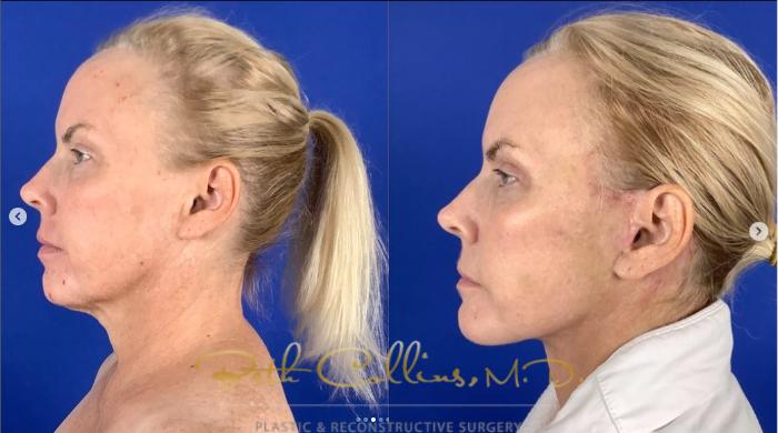 Before & After Deep Plane Facelift Case 274 Left Side View in Guilford, CT