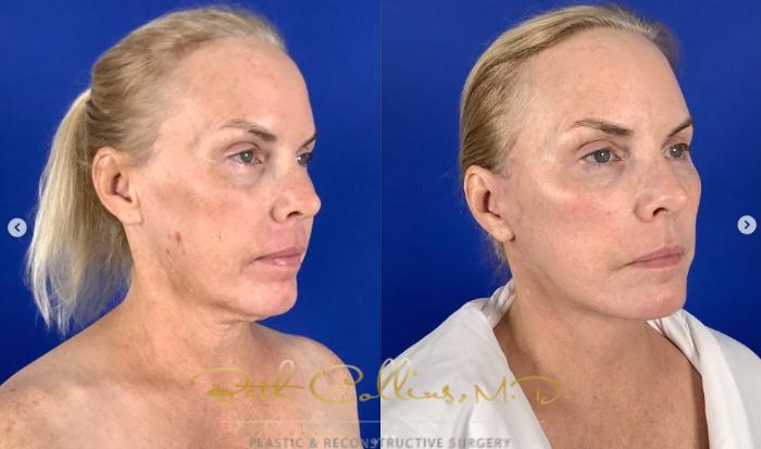 Before & After Neck Lift Case 274 Right Oblique View in Guilford, CT