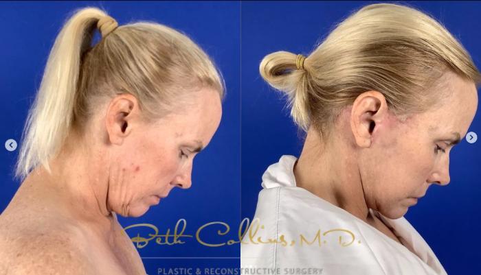 Before & After Deep Plane Facelift Case 274 Right Side - Head Bent View in Guilford, CT