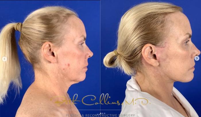 Before & After Neck Lift Case 274 Right Side View in Guilford, CT