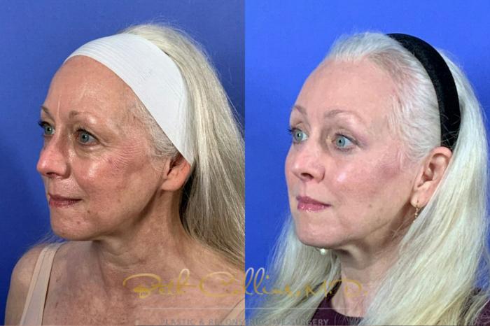 Eyelid rejuvenation with upper and lower lid blepharoplasty, endoscopic brow lift and upper lip lift