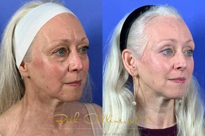 Upper and lower lid blepharoplasty with endoscopic brow lift and upper lip lift