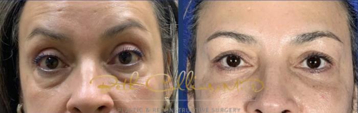 Before & After Eyelid Surgery Case 263 Front View in Guilford, CT