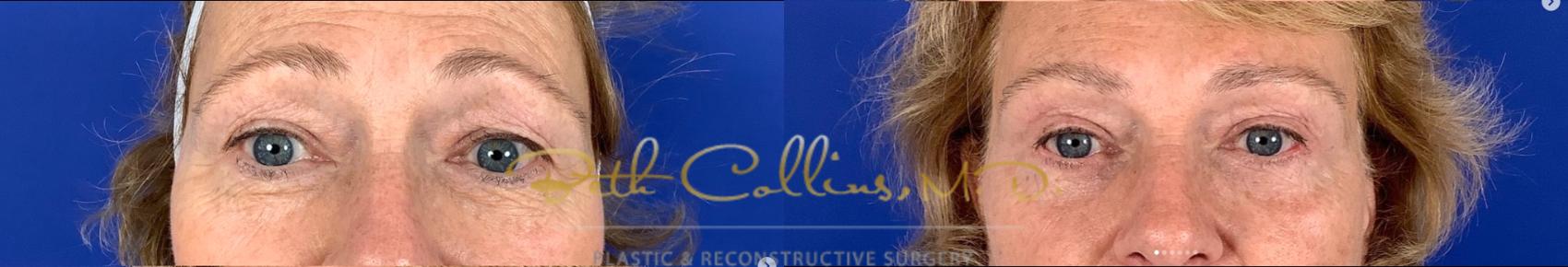 Before & After Eyelid Surgery Case 264 Front View in Guilford, CT