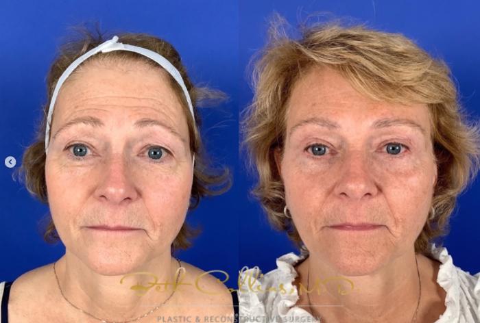 Before & After Eyelid Surgery Case 264 Front - Uncropped View in Guilford, CT