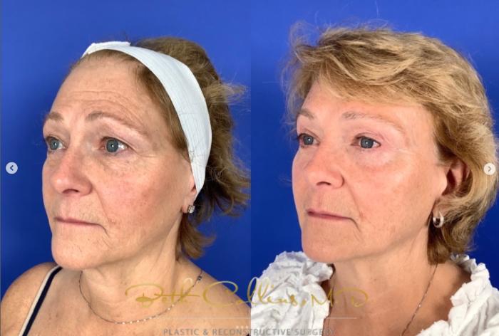 Before & After Eyelid Surgery Case 264 Left Oblique View in Guilford, CT