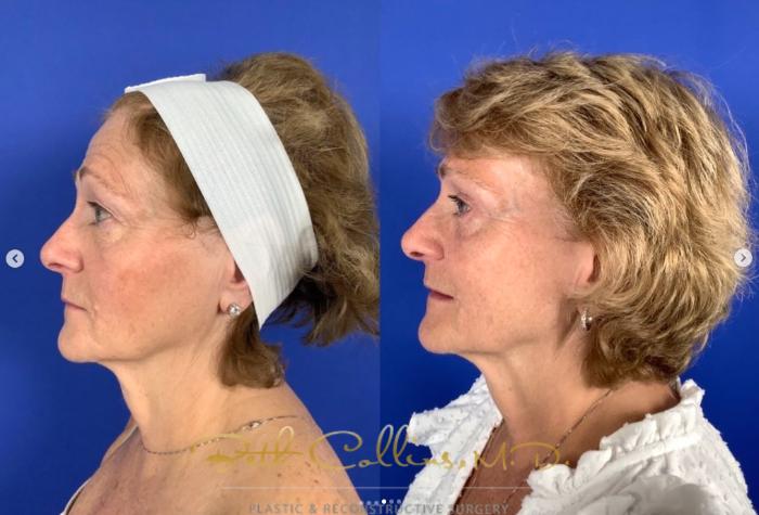 Before & After Eyelid Surgery Case 264 Left Side View in Guilford, CT