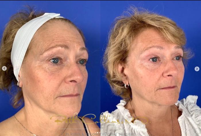 Before & After Eyelid Surgery Case 264 Right Oblique View in Guilford, CT