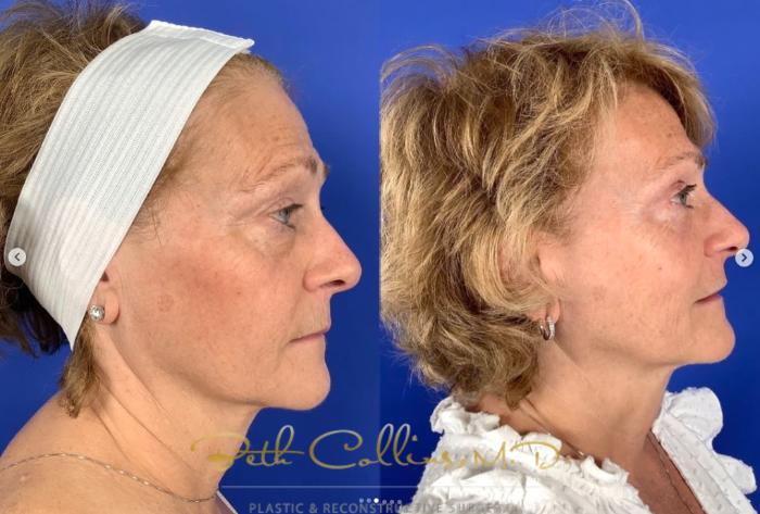 Before & After Eyelid Surgery Case 264 Right Side View in Guilford, CT