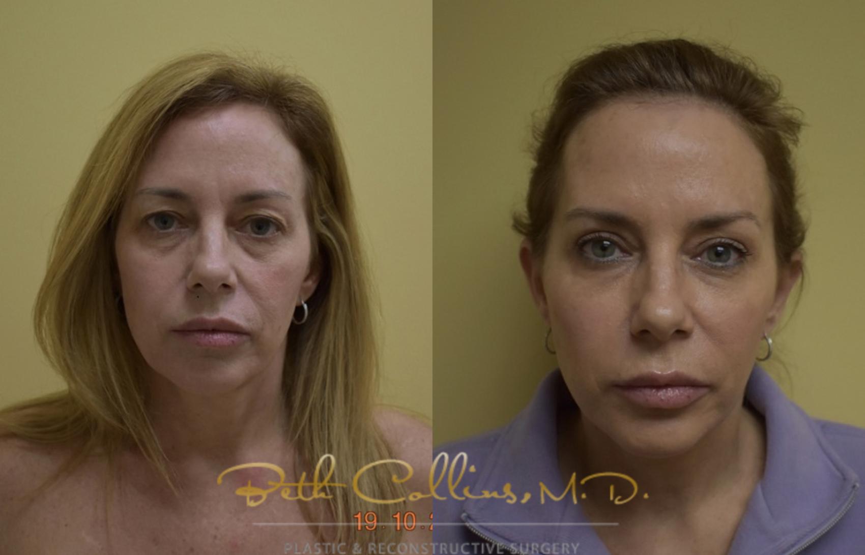 Before & After Eyelid Surgery Case 49 View #1 View in Guilford, CT