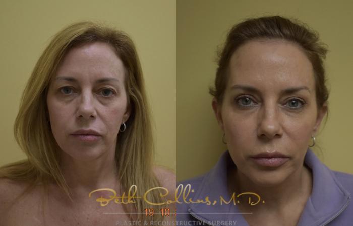 Before & After Laser Procedures Case 49 View #1 View in Guilford, CT