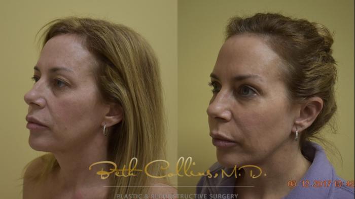 Before & After Laser Procedures Case 49 View #2 View in Guilford, CT
