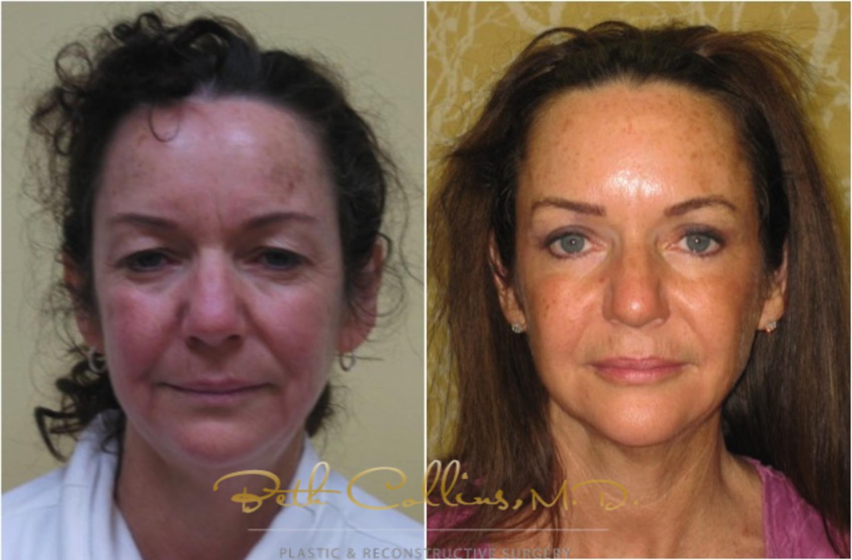 Eyelid Surgery Case 59 Before & After View #1 | Guilford, CT | Beth Collins M.D.