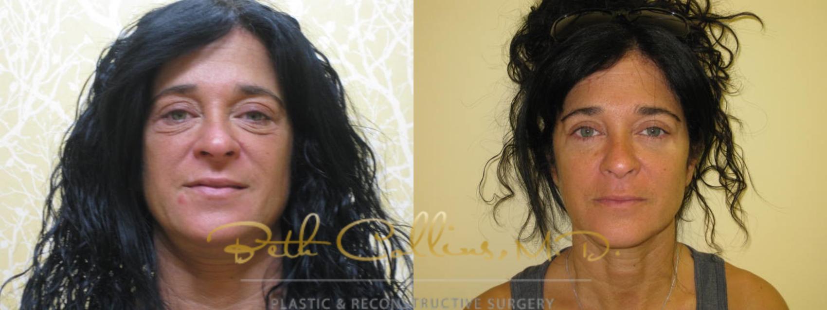 Before & After Eyelid Surgery Case 60 View #1 View in Guilford, CT
