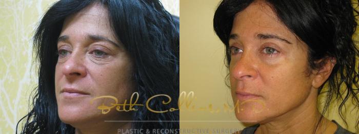 Before & After Eyelid Surgery Case 60 View #2 View in Guilford, CT