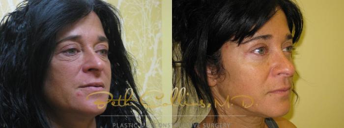 Before & After Eyelid Surgery Case 60 View #3 View in Guilford, CT