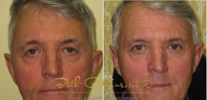 Before & After Eyelid Surgery Case 61 View #1 View in Guilford, CT