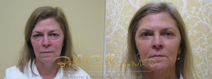 Before & After Eyelid Surgery Case 62 View #1 View in Guilford, CT