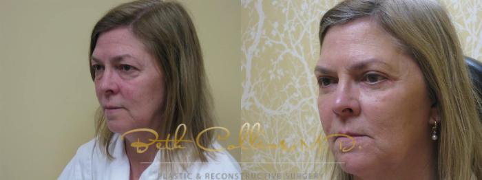 Before & After Eyelid Surgery Case 62 View #2 View in Guilford, CT