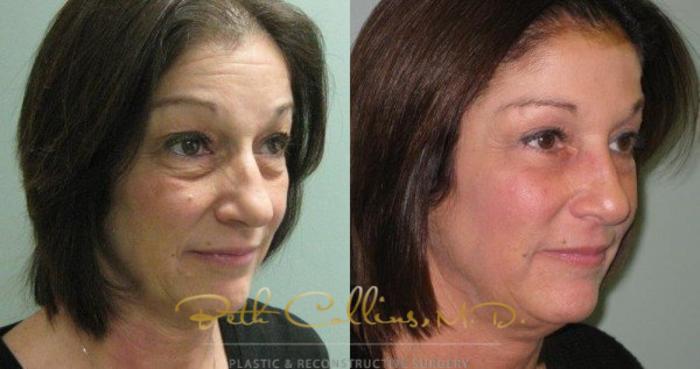 Before & After Eyelid Surgery Case 63 View #1 View in Guilford, CT