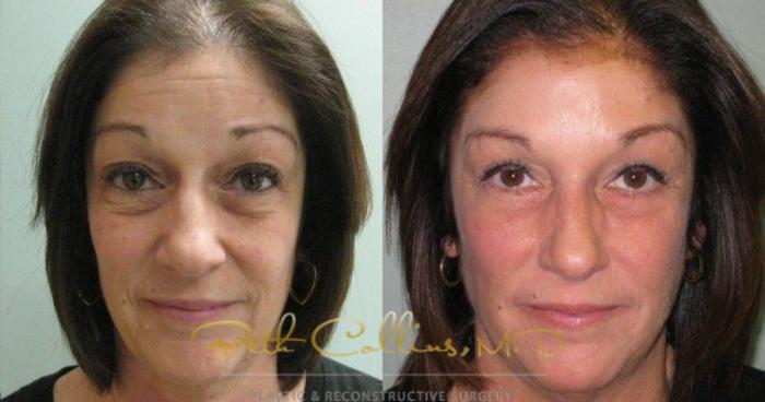 Before & After Eyelid Surgery Case 63 View #2 View in Guilford, CT