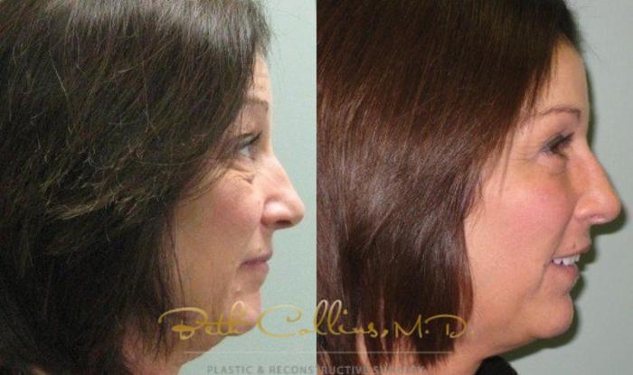 Before & After Eyelid Surgery Case 63 View #3 View in Guilford, CT