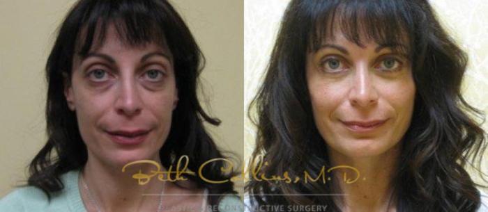 Before & After Eyelid Surgery Case 64 View #1 View in Guilford, CT
