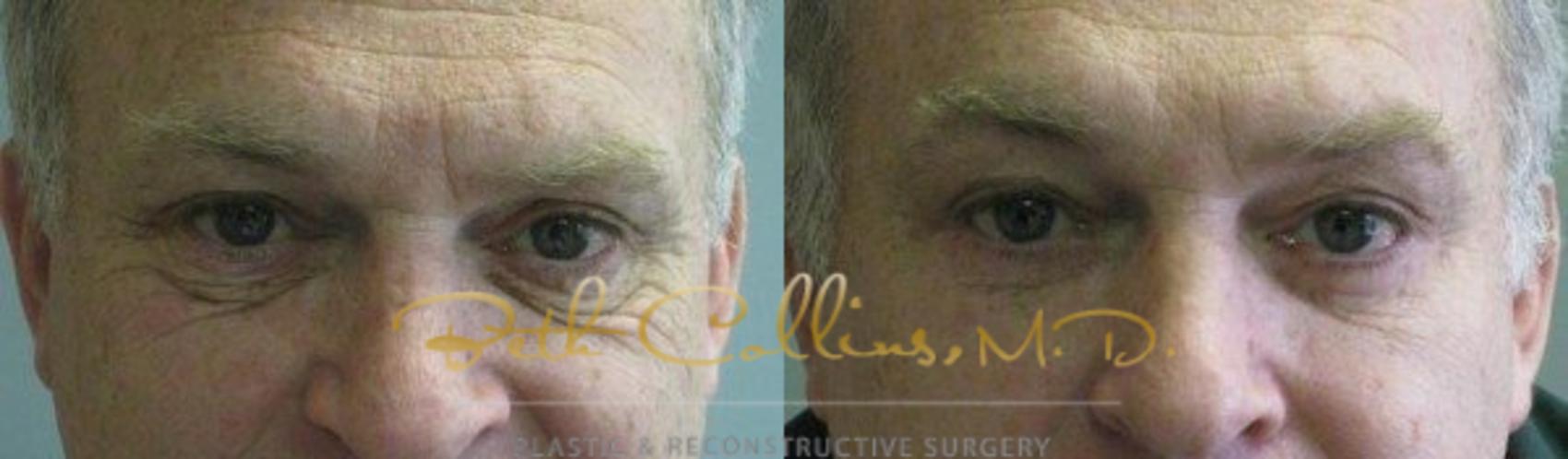 Before & After Eyelid Surgery Case 65 View #1 View in Guilford, CT