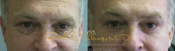 Before & After Eyelid Surgery Case 65 View #1 View in Guilford, CT