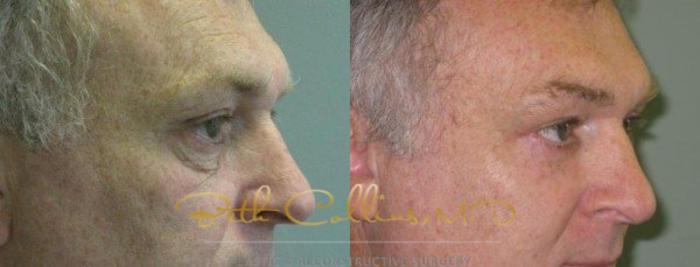 Before & After Eyelid Surgery Case 65 View #2 View in Guilford, CT