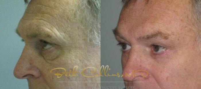 Before & After Eyelid Surgery Case 65 View #4 View in Guilford, CT