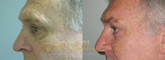 Before & After Eyelid Surgery Case 65 View #5 View in Guilford, CT
