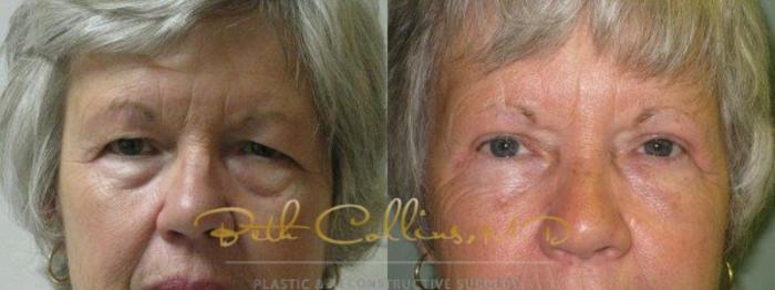 Before & After Eyelid Surgery Case 67 View #1 View in Guilford, CT