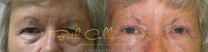 Before & After Eyelid Surgery Case 67 View #2 View in Guilford, CT