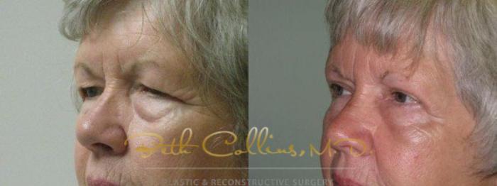 Before & After Eyelid Surgery Case 67 View #3 View in Guilford, CT