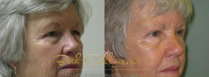 Before & After Eyelid Surgery Case 67 View #4 View in Guilford, CT