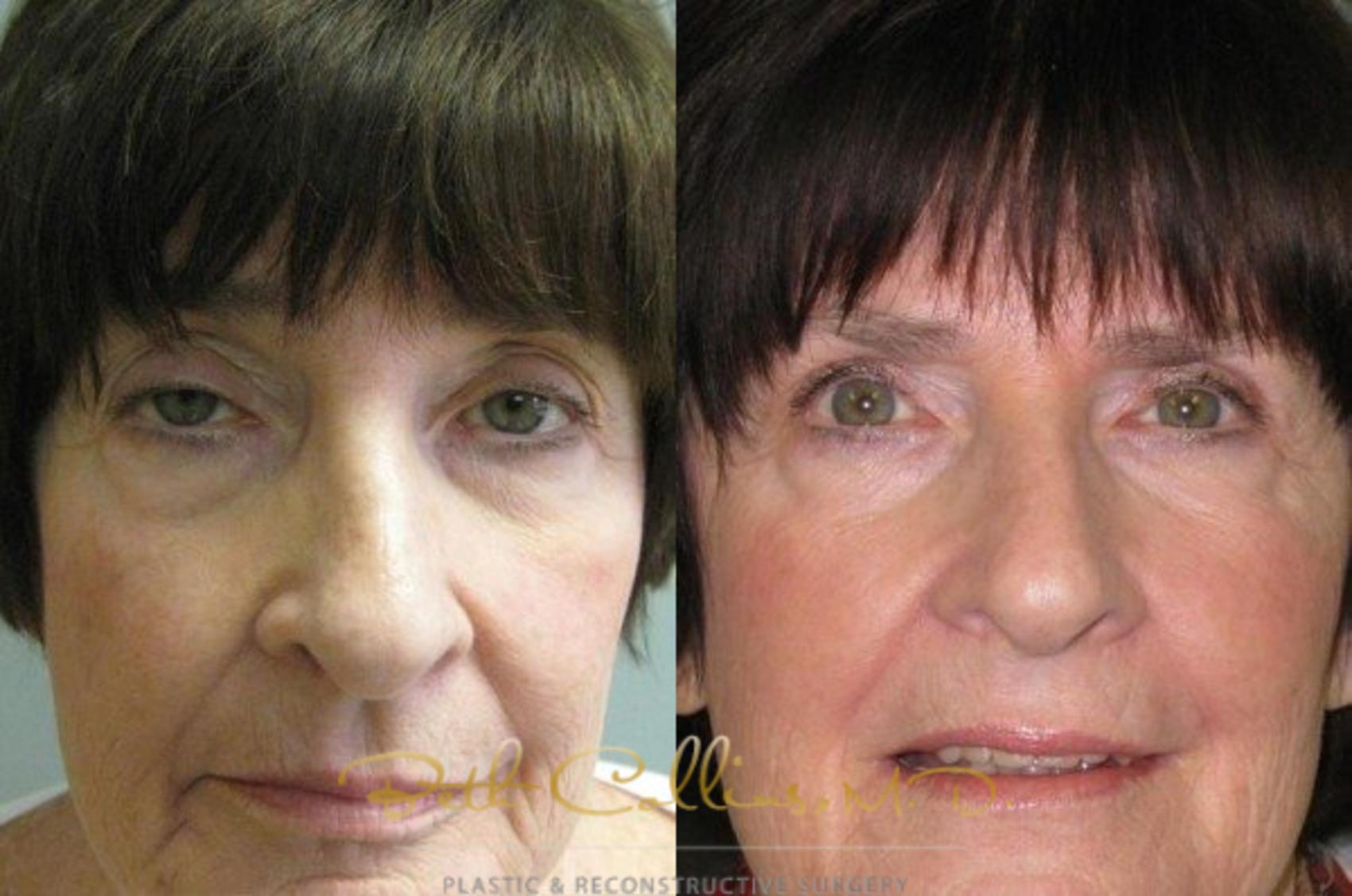 Before & After Eyelid Surgery Case 68 View #1 View in Guilford, CT