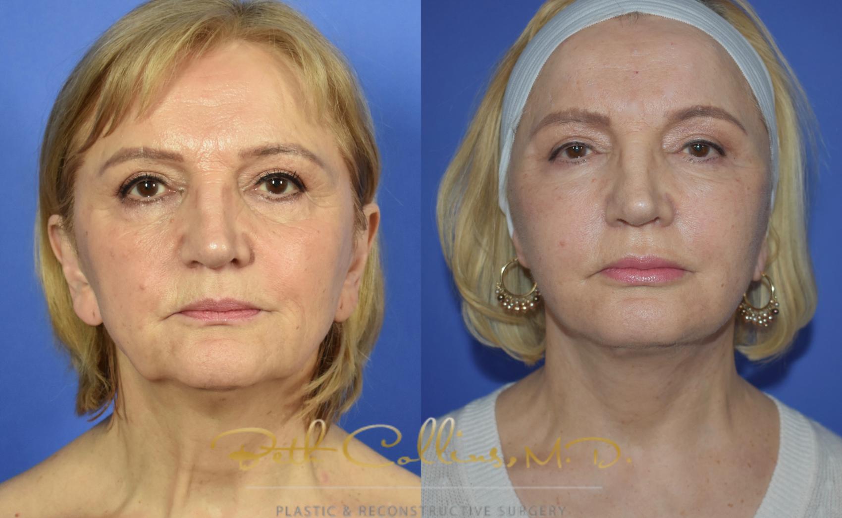 Before & After Facelift Case 103 View #1 View in Guilford, CT