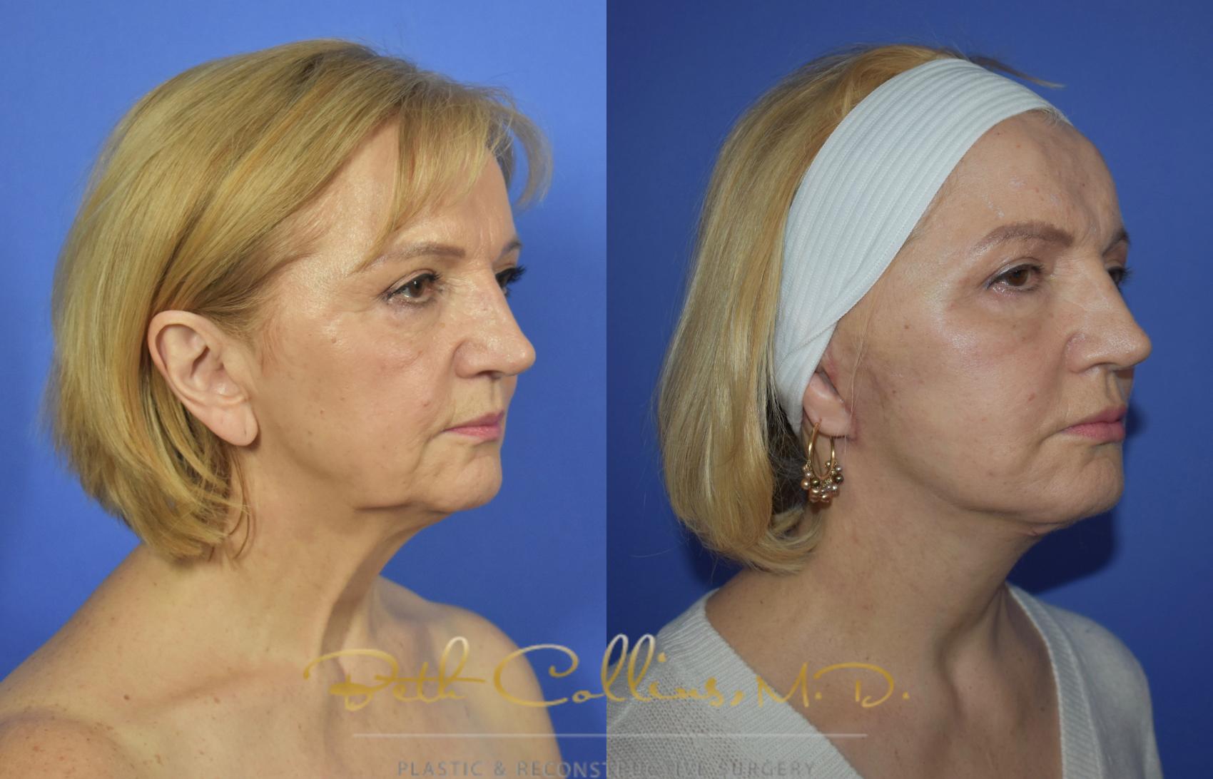 Facelift Case 103 Before & After View #2 | Guilford, CT | Beth Collins M.D.