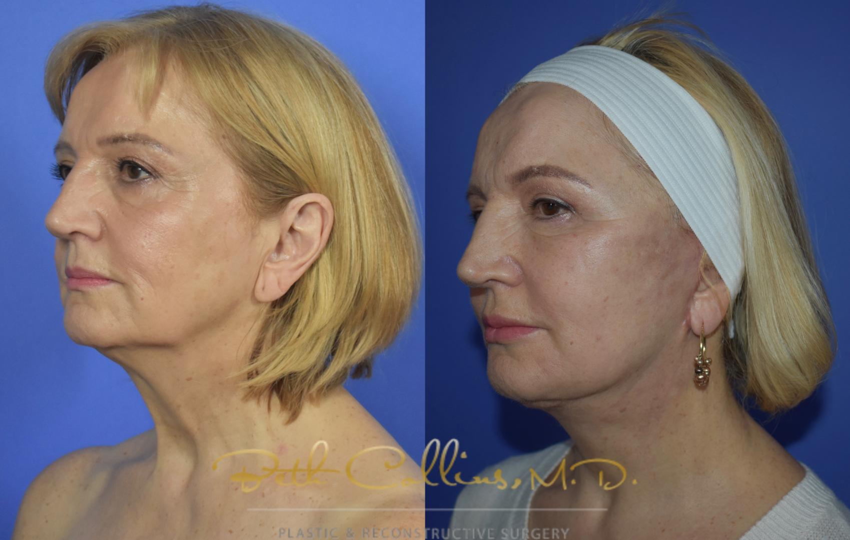 Before & After Facelift Case 103 View #3 View in Guilford, CT