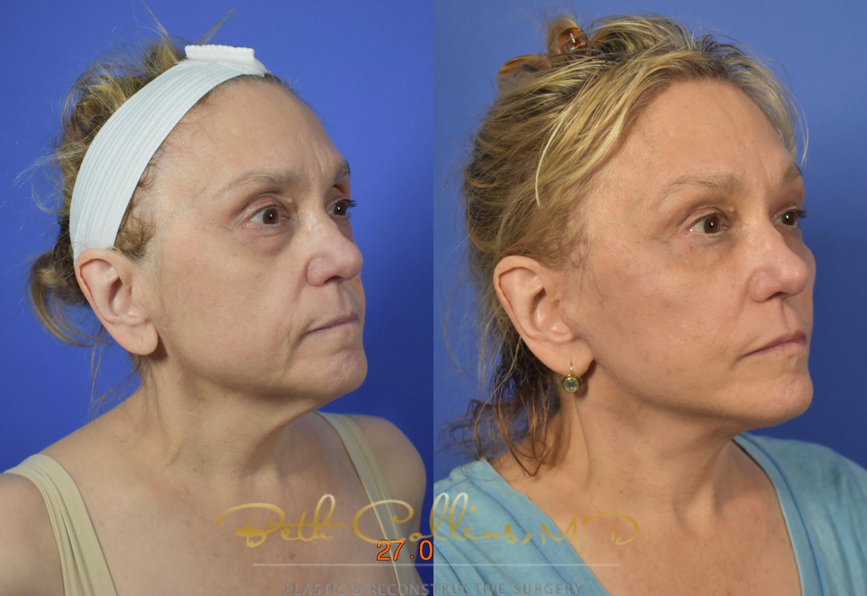 Facelift Case 105 Before & After View #1 | Guilford, CT | Beth Collins M.D.