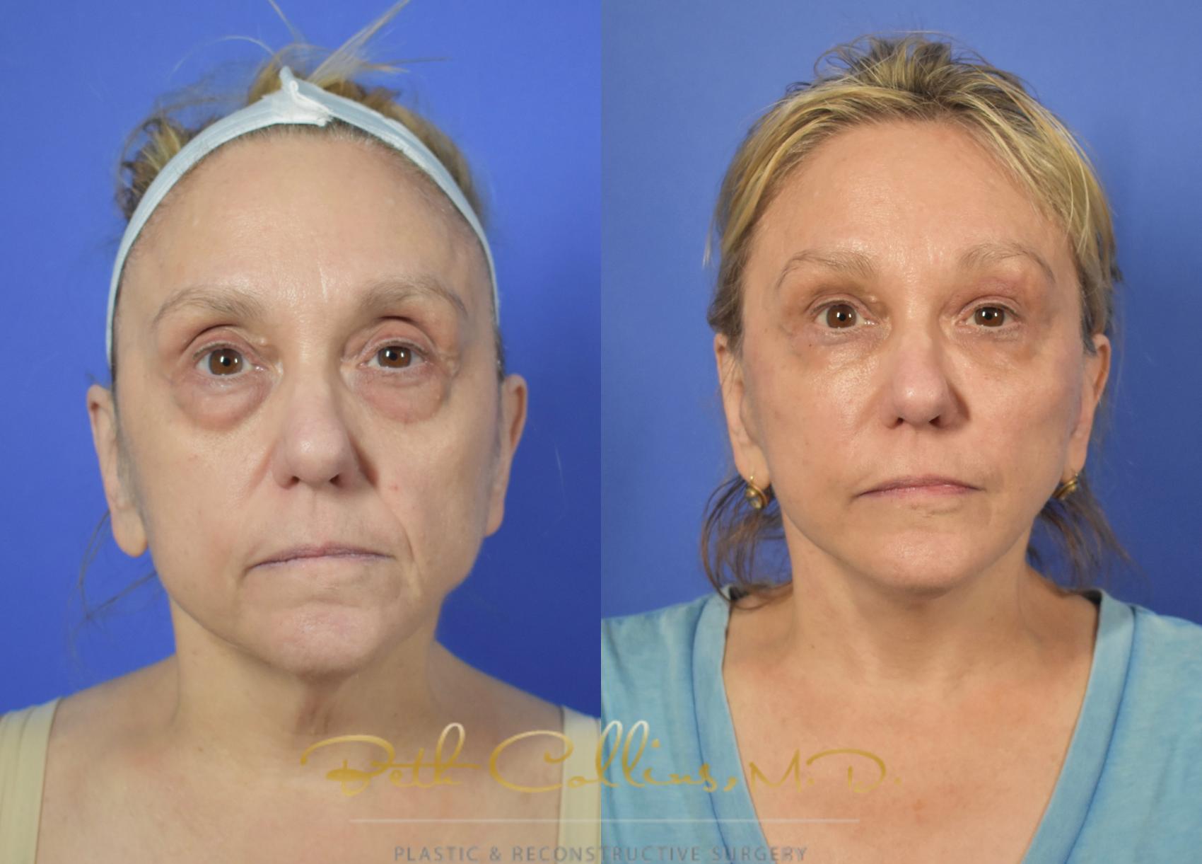 Facelift Case 105 Before & After View #2 | Guilford, CT | Beth Collins M.D.