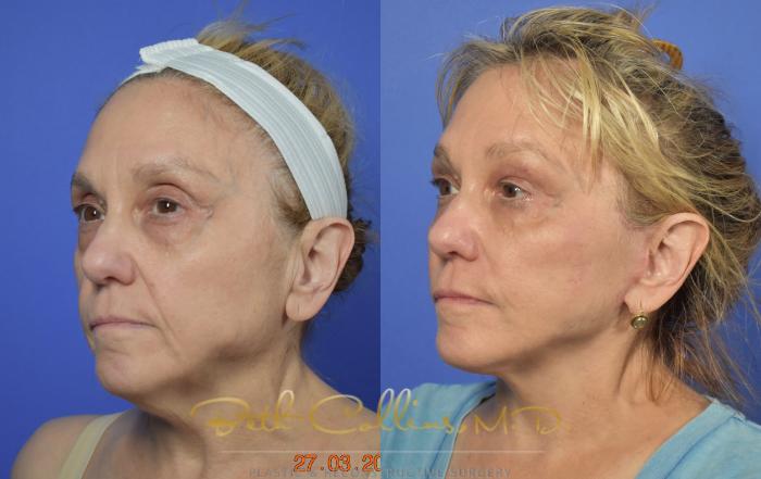 Before & After Facelift Case 105 View #3 View in Guilford, CT