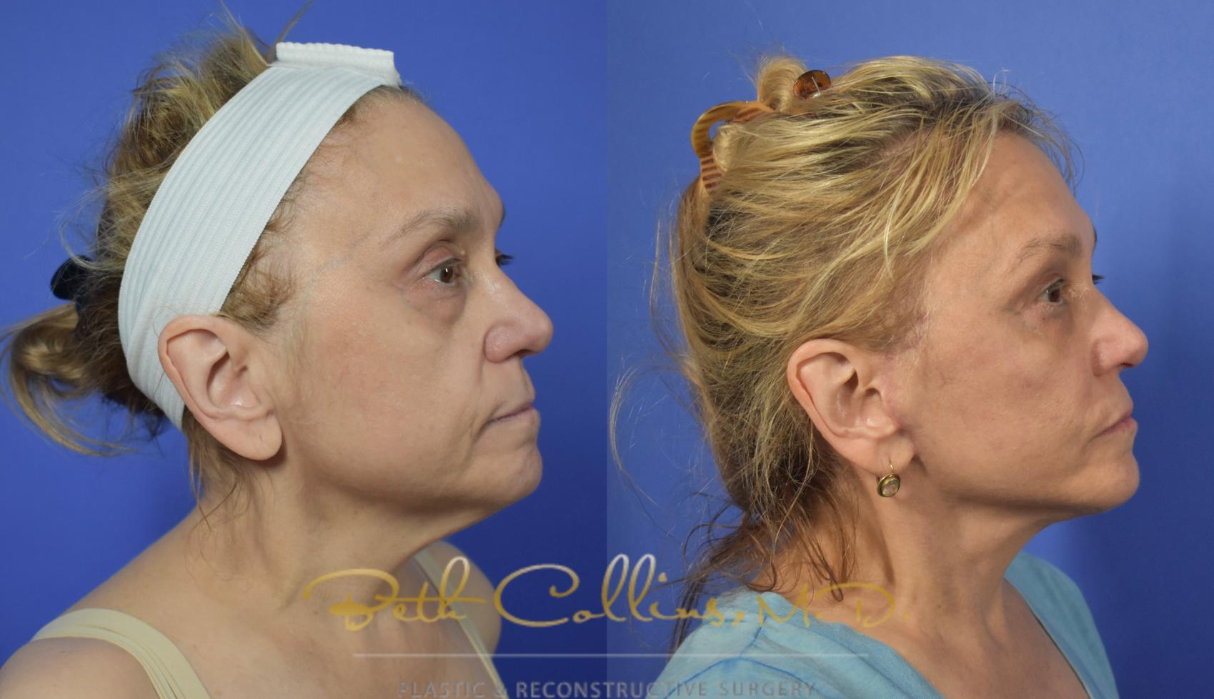 Facelift Case 105 Before & After View #4 | Guilford, CT | Beth Collins M.D.
