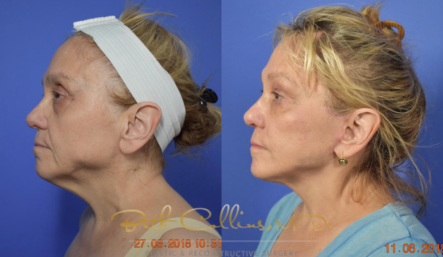 Facelift Case 105 Before & After View #5 | Guilford, CT | Beth Collins M.D.