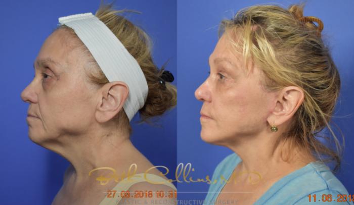 Before & After Facelift Case 105 View #5 View in Guilford, CT