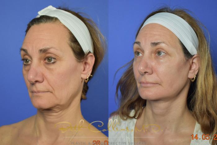 Before & After Facelift Case 106 View #1 View in Guilford, CT